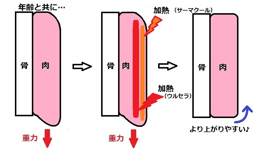 たるみ模式図サーマウルセラ.jpg