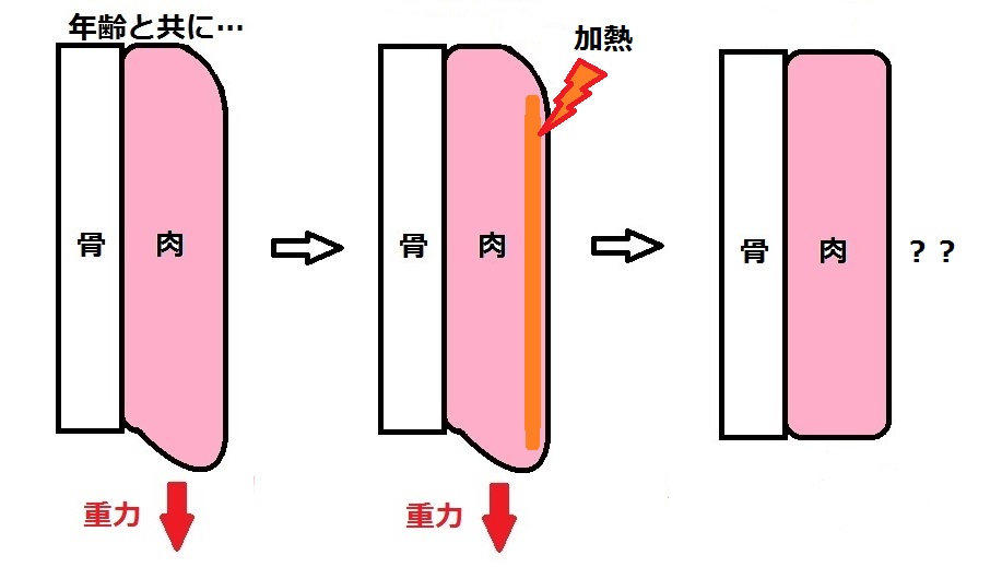 たるみ模式図サーマクール.jpg