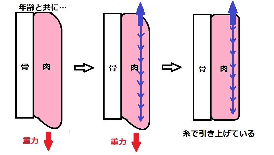 たるみ模式図糸引き上げ.jpg