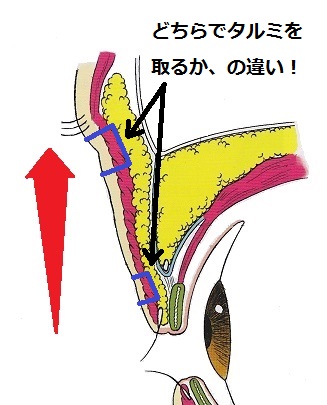 眉下とタルミ取り.jpg