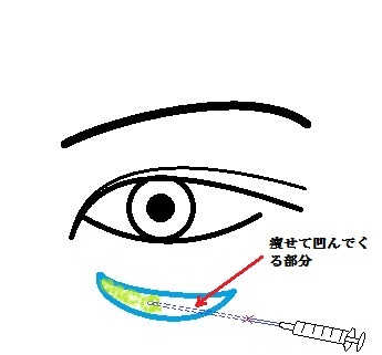 眼の下注入.jpg