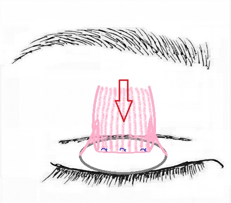 眼瞼挙筋腱膜前転術.jpg