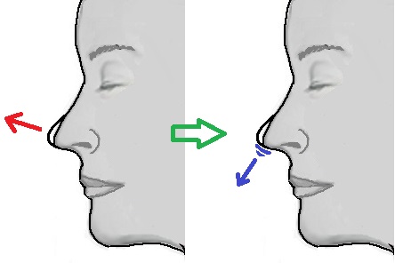 鼻尖への軟骨移植.jpg