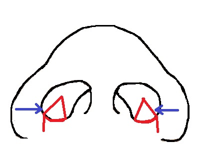 鼻模式図flap法.jpg