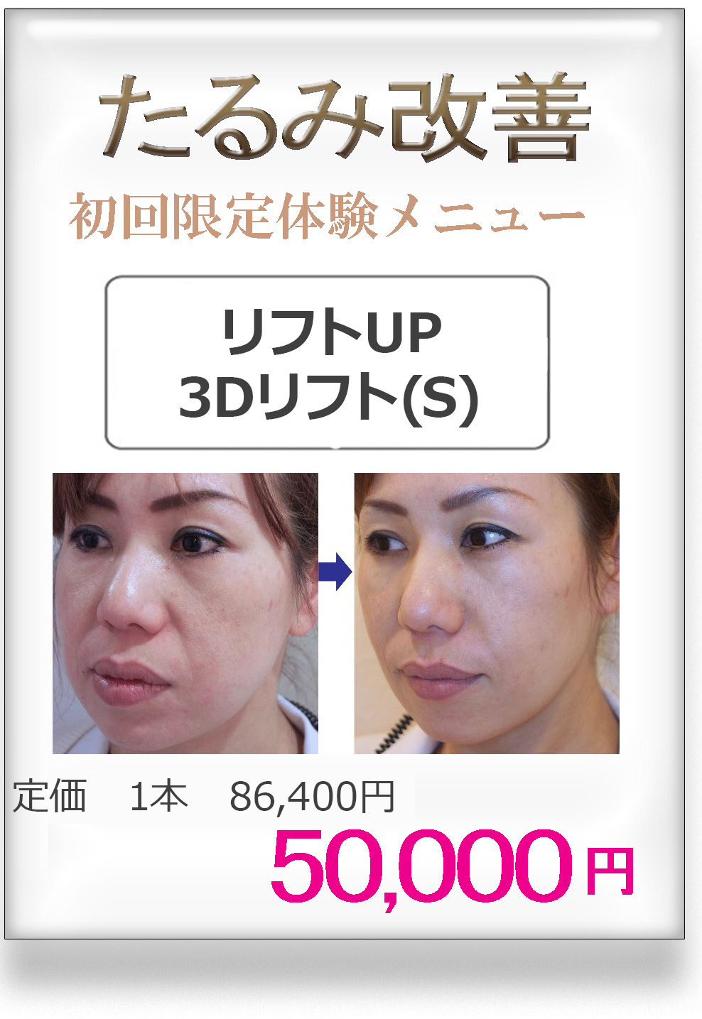 たるみ改善治療に3Dリフト/美容外科ピュアメディカルクリニック/奈良・大阪・京都
