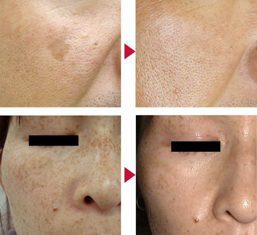 Qスイッチルビーレーザー スマホテスト