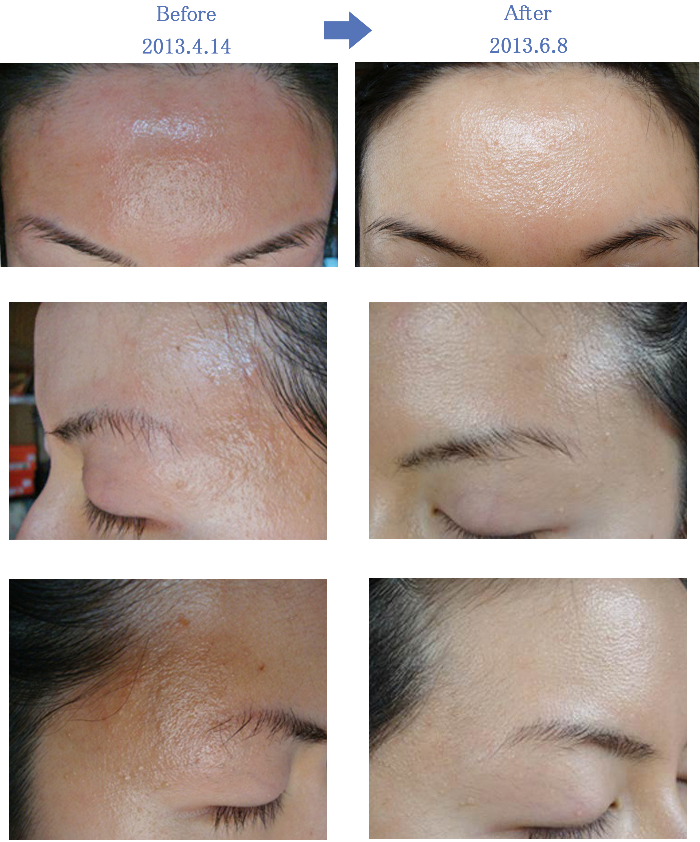 大人のアトピー性皮膚炎治療モニター画像13 お顔 額 こめかみ改善 美容外科 美容皮膚科 奈良ピュアメディカルクリニック