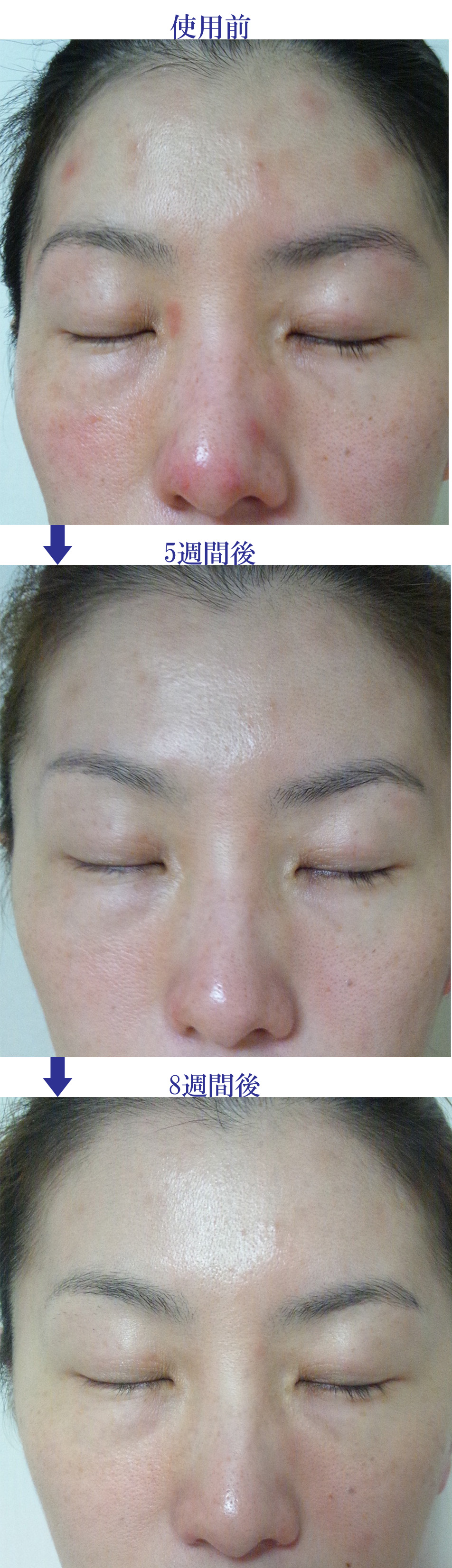 アトピー性皮膚炎改善症例16（顔・鼻のかゆみ・炎症の赤み改善）