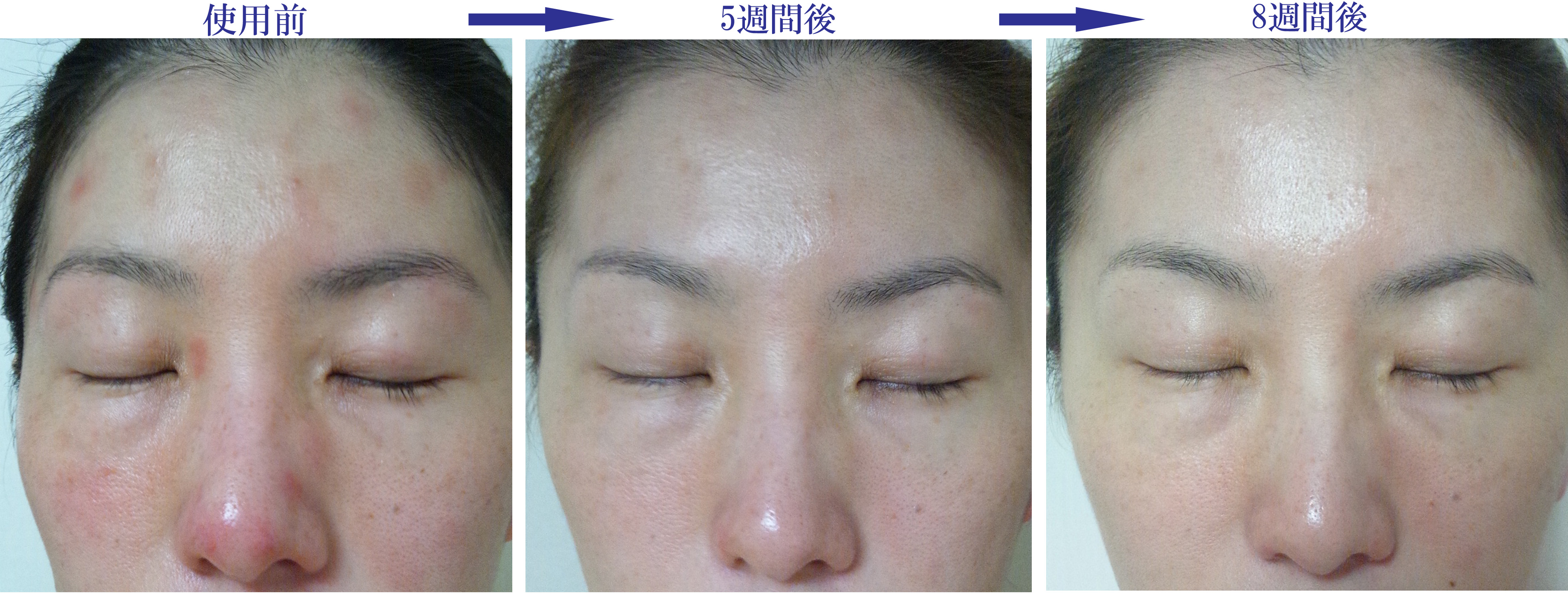 アトピー性皮膚炎改善症例16（顔・鼻のかゆみ・炎症の赤み改善）