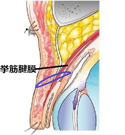 一重まぶた構造挙筋法.jpg