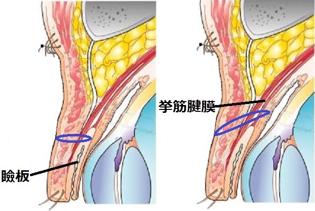 一重まぶた構造瞼板挙筋法.jpg