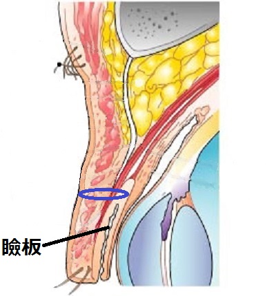 一重まぶた構造瞼板法.jpg