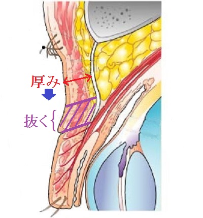 上瞼たるみ取り断面図.jpg