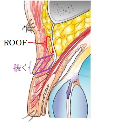 上瞼たるみ取り断面図ROOF.jpg