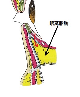 目の下脱脂.jpg