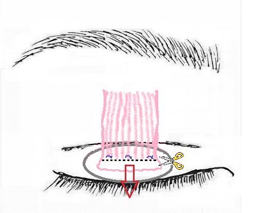 眼瞼挙筋腱膜前転術2.jpg