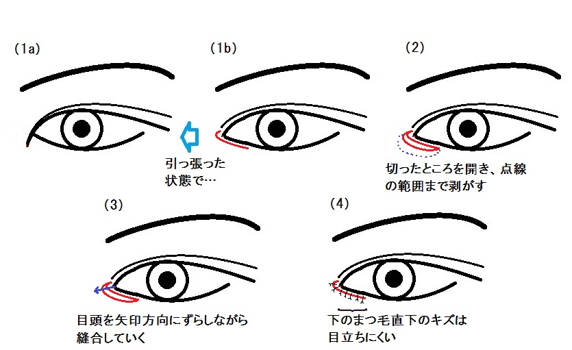 韓流目頭切開なるもの 奈良 東大阪 京都 三重 和歌山 美容外科 美容皮膚科 奈良ピュアメディカルクリニック