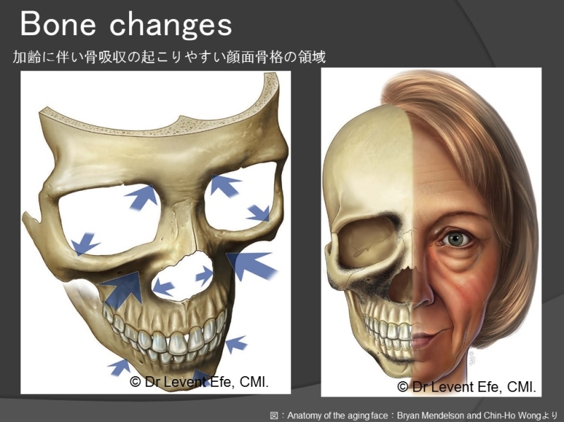 顔面の骨吸収.jpg