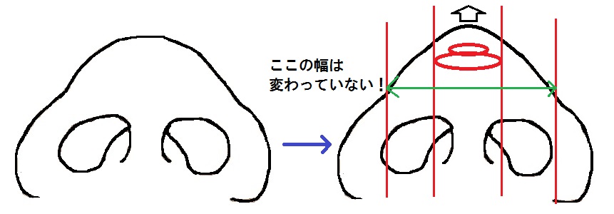 鼻尖軟骨移植模式図3.jpg