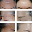 大人のアトピー性皮膚炎治療モニター画像13（お顔・額・こめかみ改善）