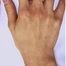 ラ（レ）ディエッセで筋張った手の甲をふっくら症例/美容整形外科「ピュアメディカルクリニック」/奈良・大阪・京都・三重・和歌山