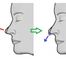 ☆鼻尖軟骨移植だけするのはアリ？☆／奈良・東大阪・京都・三重・和歌山