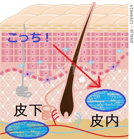 hyaluronic打ち分けα.jpg