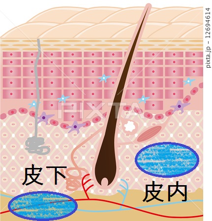 hyaluronic打ち分け.jpg