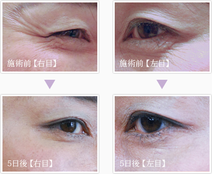 目元若返り before after