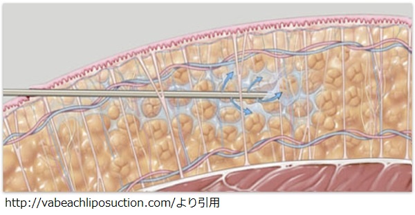 liposuctioninfiltration.jpg