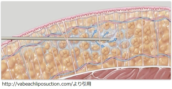 liposuctioninfiltration.jpg