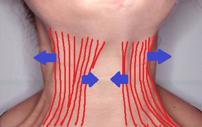 neck-bands-platysma治し方.jpg