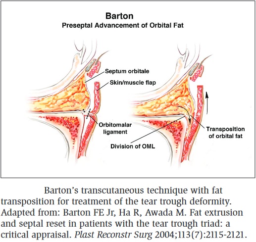 repositioningorbitalfat.jpg