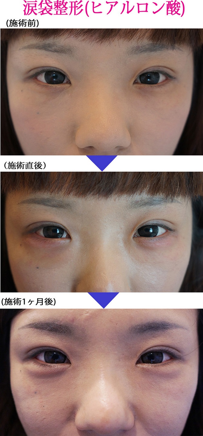 涙袋が腫れる 目の周り、まぶたや涙袋の周りがとても腫れます