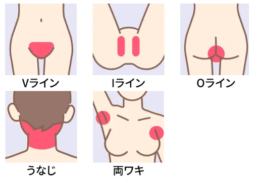脱毛
