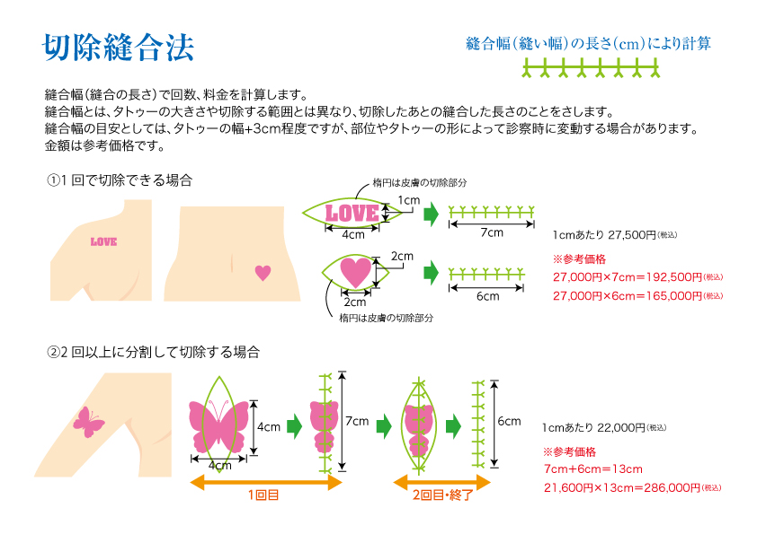 切除縫合法イメージ