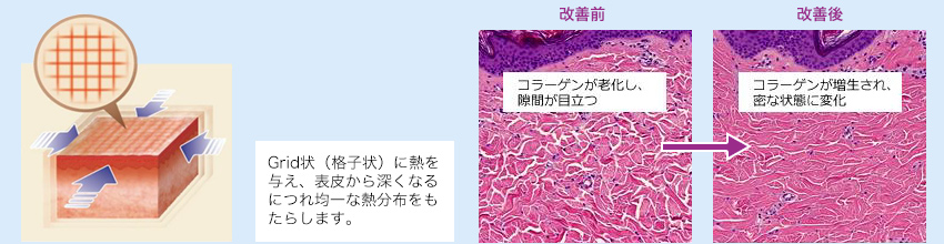 イントラジェンの作用