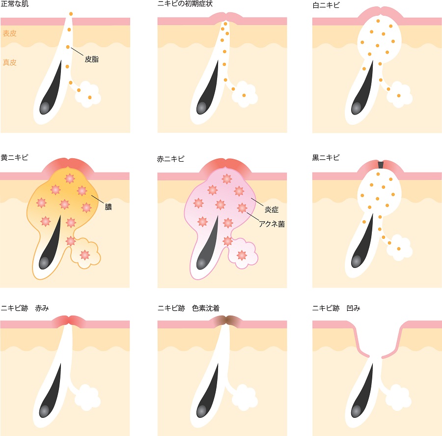 繰り返すしつこいニキビの種類と治療｜美容外科皮膚科ピュアメディカルクリニック奈良橿原王寺