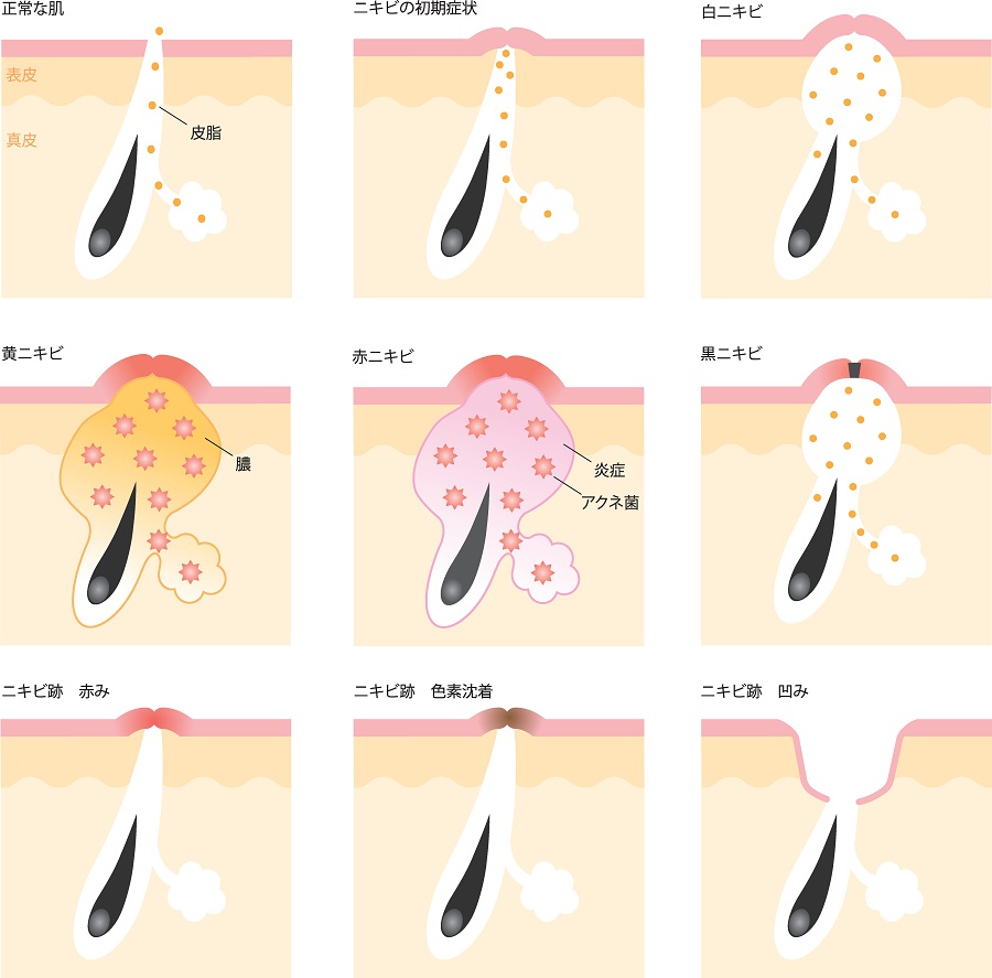 にきび毛穴詰まりの説明｜美容外科皮膚科ピュアメディカルクリニック奈良