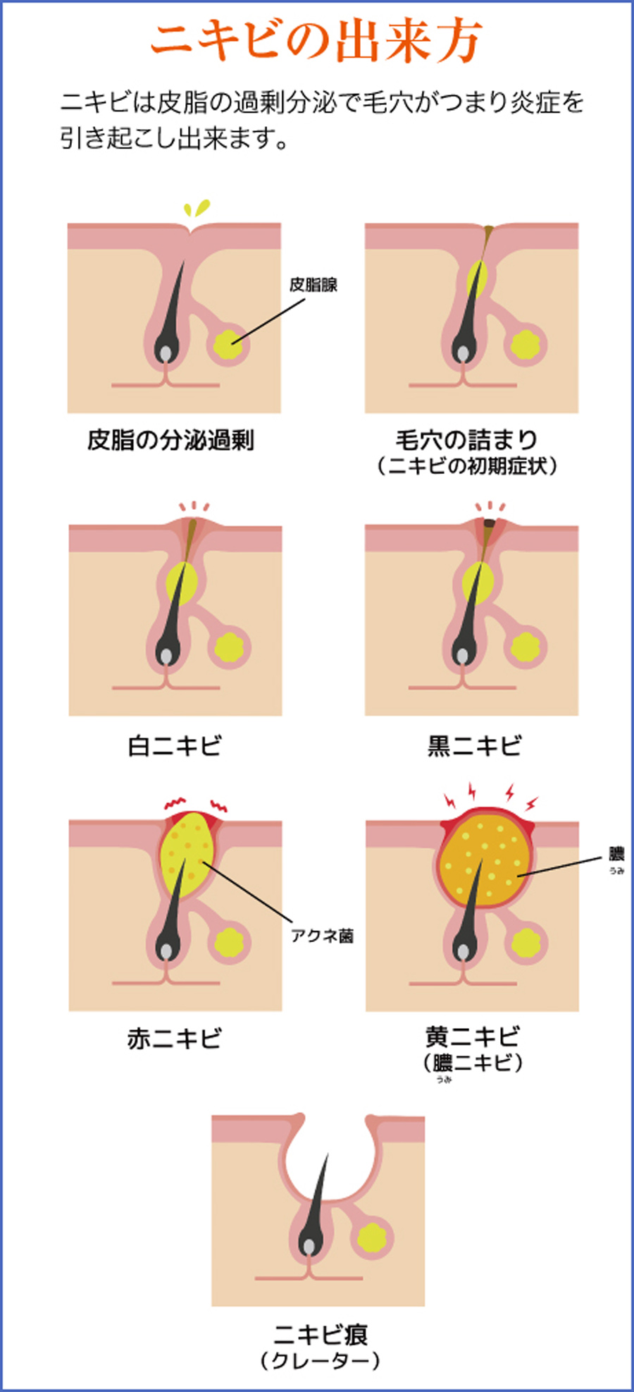 にきび毛穴詰まりの説明｜美容外科皮膚科ピュアメディカルクリニック奈良