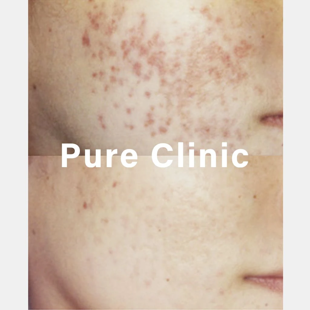 ジェネシスによるにきび・にきび跡の改善