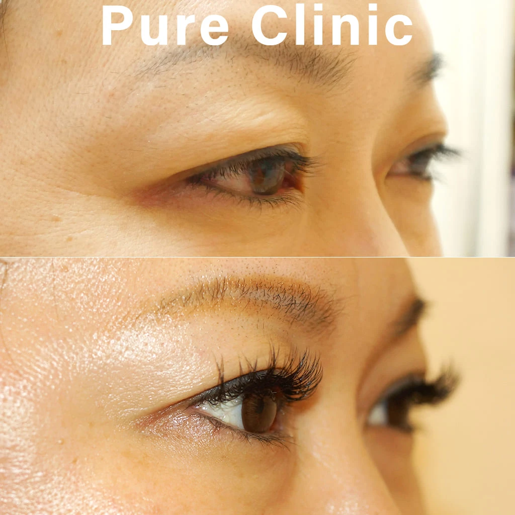 上眼瞼しわ取り術