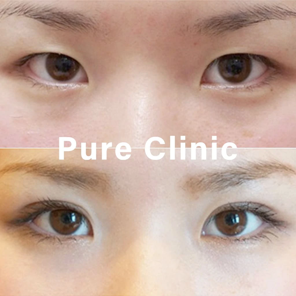 二重埋没法による二重形成