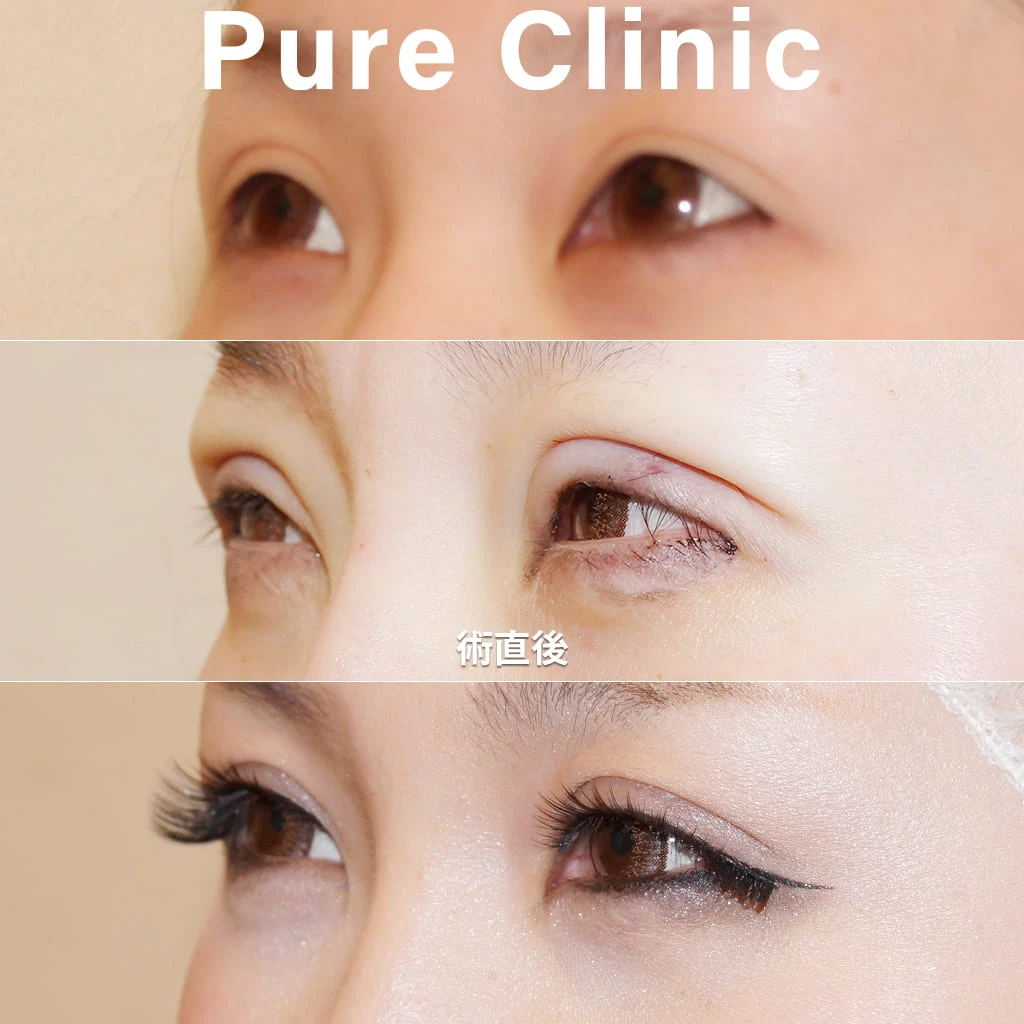 全切開+脱脂による二重形成