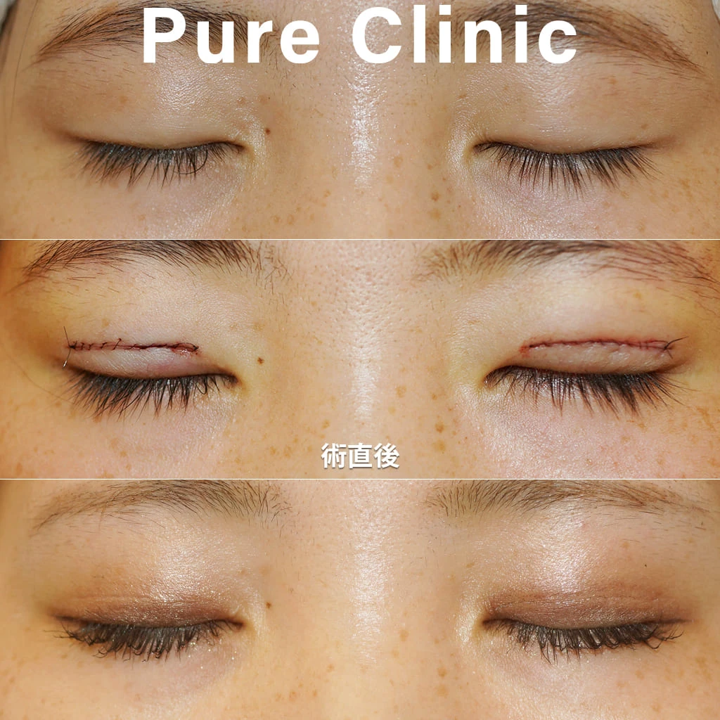 全切開+脱脂による二重形成