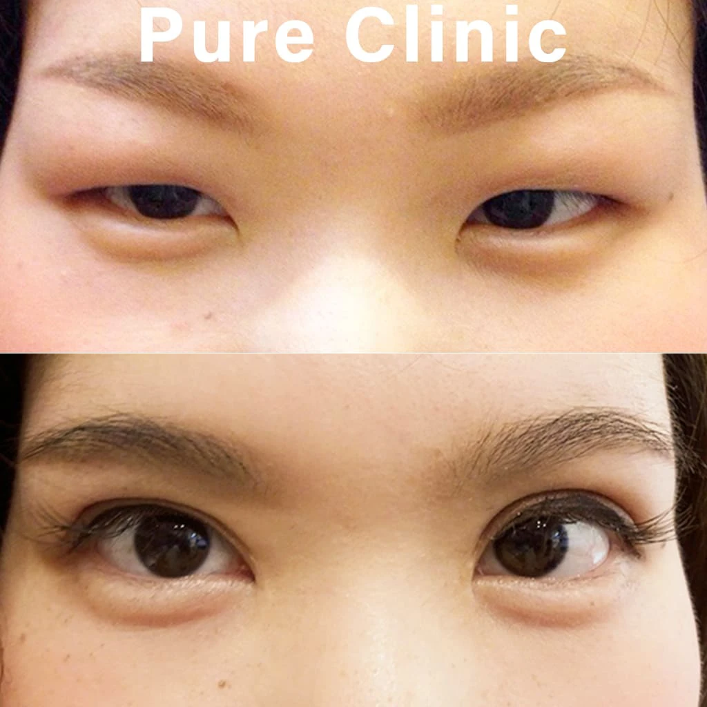 目頭切開による目もと改善