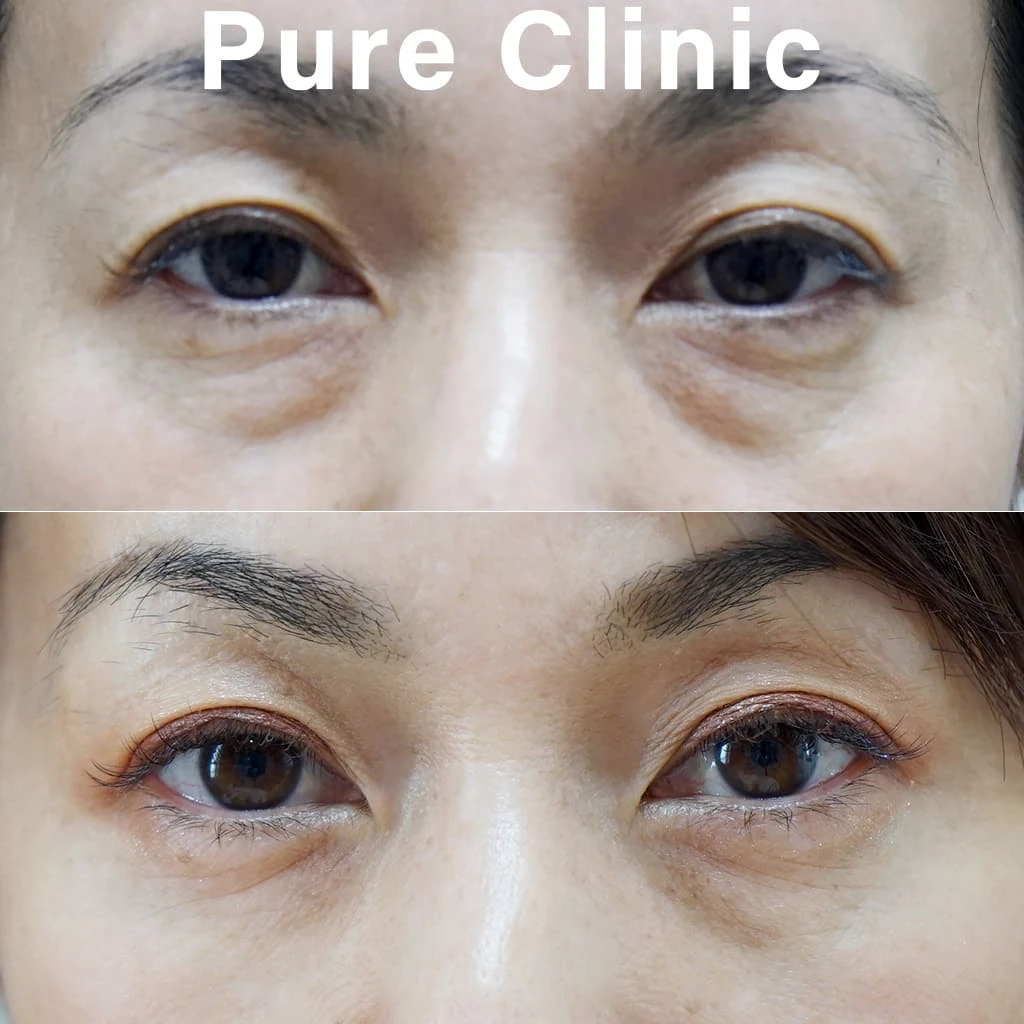 経結膜下脱脂術による目もと改善