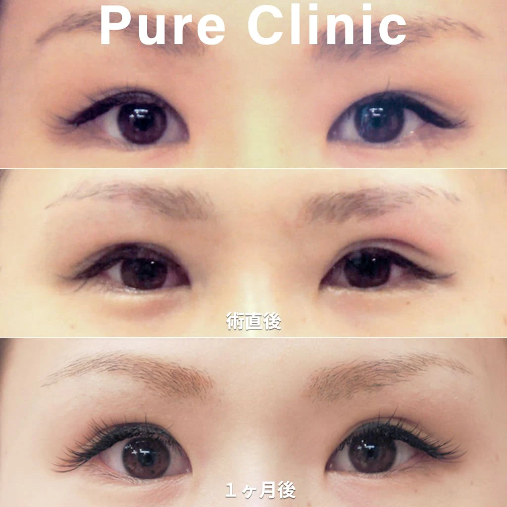 二重埋没法+脱脂による二重形成