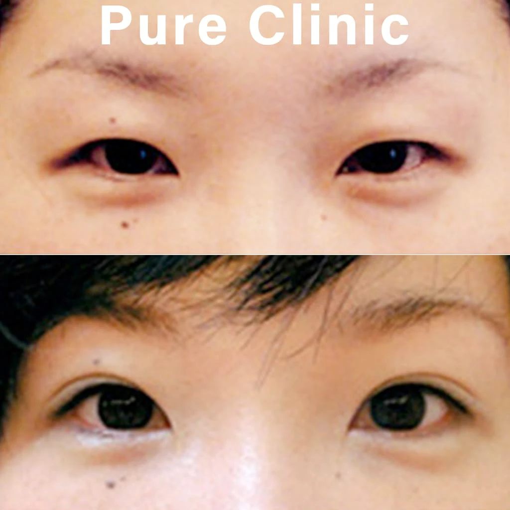 二重埋没法による二重形成