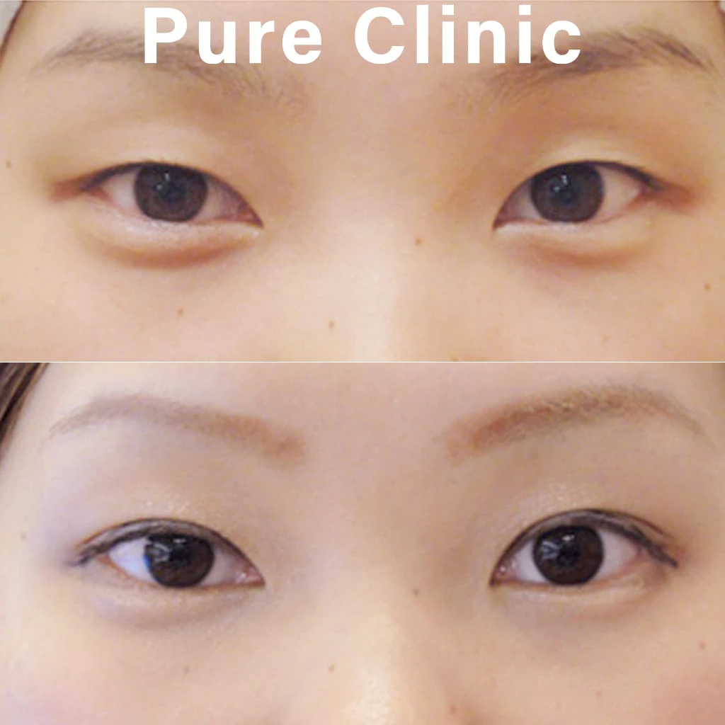 二重埋没法による二重形成